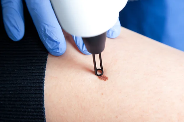 LASER Mole & Blemish Removal